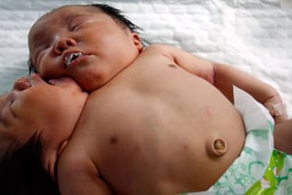 In China geborene Siamesische Zwillinge teilen sich einen Körper und die meisten Organe