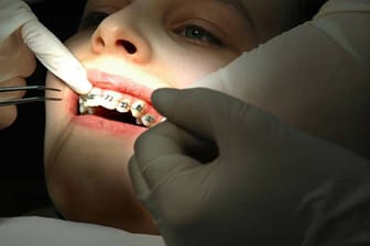 Zahnspange - unbeliebt bei den Kids, aber wertvoll für die Kieferregulierung.