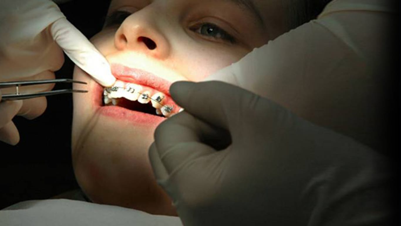Zahnspange - unbeliebt bei den Kids, aber wertvoll für die Kieferregulierung.