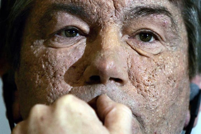 ... gegen den Oppositionskandidaten Viktor Juschtschenko an. Dieser wird während des Wahlkampfs mit Dioxin vergiftet, wie sich später herausstellt. Das Gift hinterlässt tiefe Narben in seinem Gesicht.