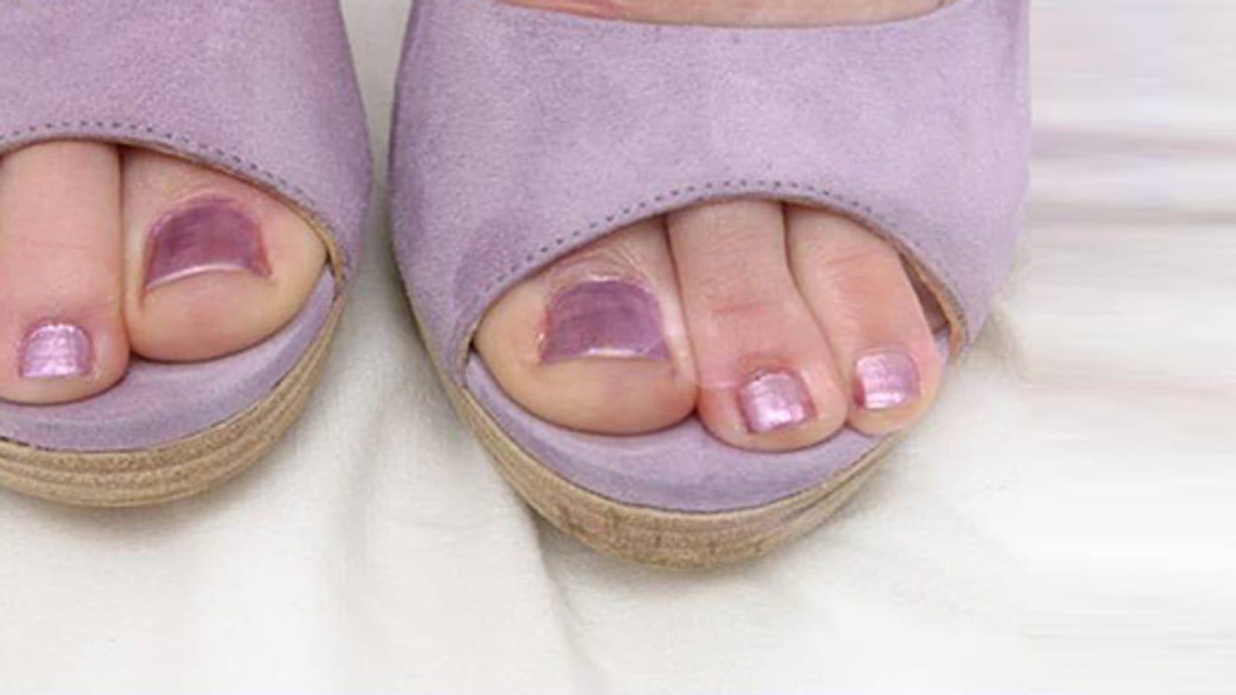 Eingewachsener Fußnagel: Enges und unbequemes Schuhwerk ist häufig die Ursache.