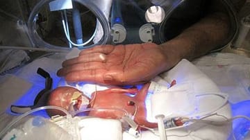 Als Melinda Guido Ende August geboren wurde, gaben ihr die Ärzte in Los Angeles eine Überlebenschance von ein bis zwei Prozent.