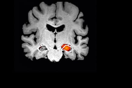 Neues Verfahren für Alzheimer.