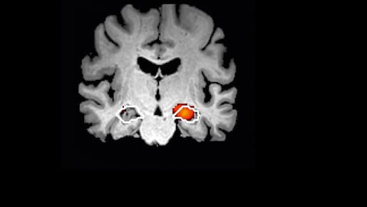 Neues Verfahren für Alzheimer.