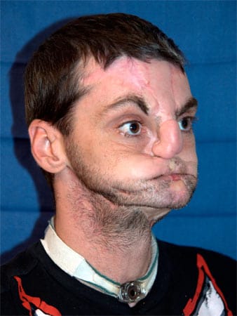 Zwar war er danach mehrfach operiert worden, doch konnte er seinen Mund kaum benutzen. Zwar war er danach mehrfach operiert worden, doch konnte er seinen Mund kaum benutzen.