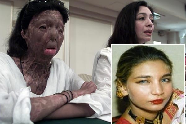 Fakhra Younus vor und nach dem Säureanschlag