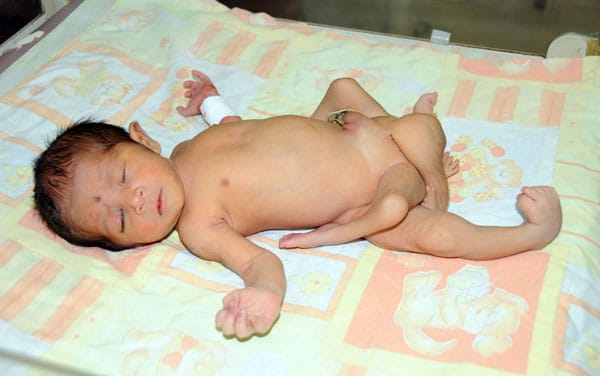 In Pakistan ist ein Baby mit sechs Beinen auf die Welt gekommen. Der kleine Junge hat eine äußerst seltene genetische Krankheit.