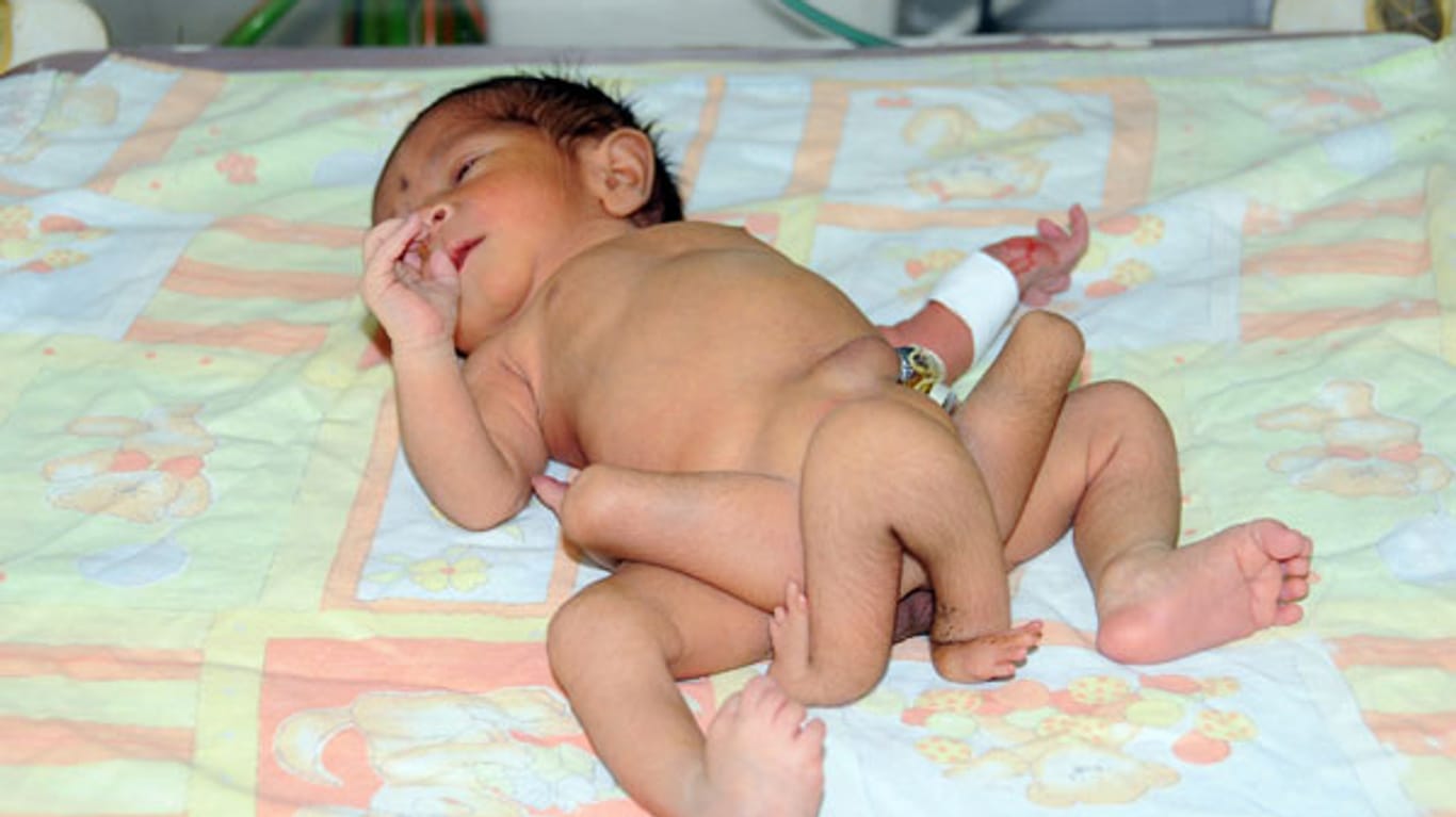 In Pakistan kam ein Baby mit sechs Beinen zur Welt