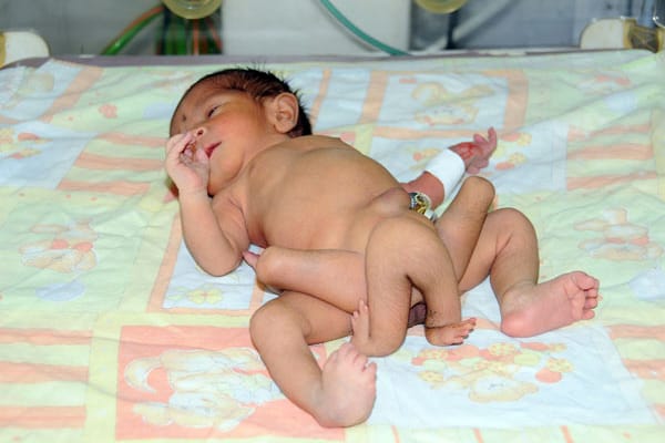 In Pakistan kam ein Baby mit sechs Beinen zur Welt