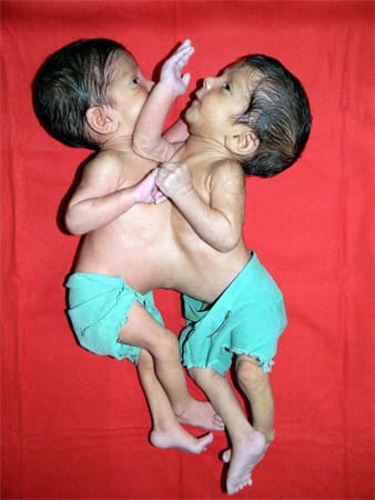 Stuti und Aradhna wurden am 2. Juli 2011 in der indischen Stadt Betul (Bundesstaat Pradesh) geboren.