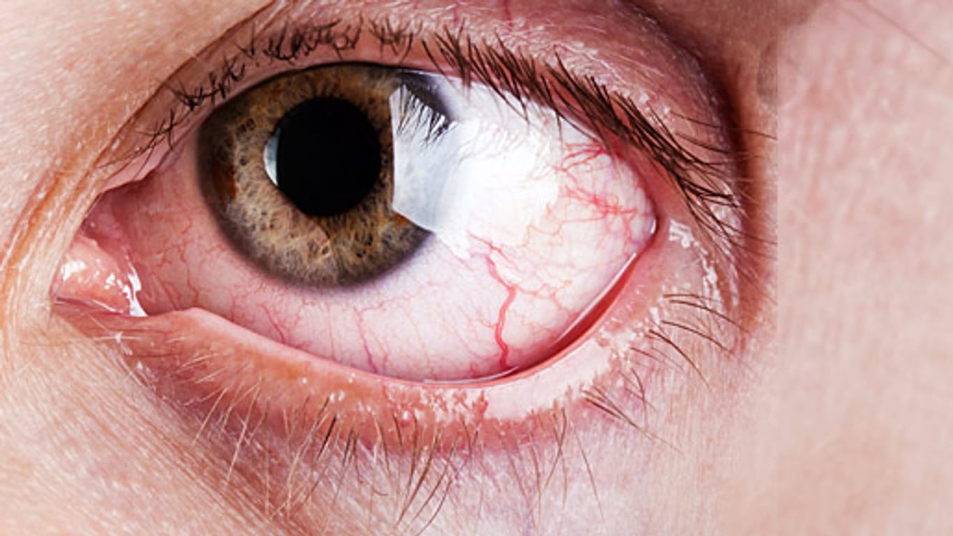 Orbithopathie: Eine kranke Schilddrüse schadet auch dem Auge.