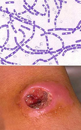Menschen stecken sich seltener an. Hier - violett eingefärbt - eine mikroskopische Aufnahme von Milzbrand-Erregern (Bacillus Anthracis). Bei infizierten Menschen kann die Krankheit unter anderem zu Hautveränderungen führen. Menschen stecken sich seltener an. Hier - violett eingefärbt - eine mikroskopische Aufnahme von Milzbrand-Erregern (Bacillus Anthracis). Bei infizierten Menschen kann die Krankheit unter anderem zu Hautveränderungen führen.