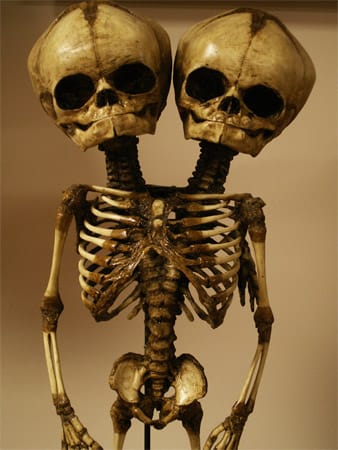 Alte Zeichnungen und Skulpturen zeigen, dass es siamesische Zwillinge schon immer gegeben hat. Die Abbildung zeigt ein Skelett von siamesischen Zwillingen mit zwei Köpfen, die sich einen Körper teilen. Alter und Herkunft sind nicht bekannt.