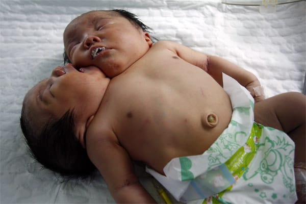 Zwei Köpfe, aber nur ein Körper: Im Mai 2011 wurden in China siamesische Zwillinge geboren, die sich fast alle Organe teilen. Nur die Wirbelsäule, Speiseröhre und die linke Herzkammer liegen doppelt vor. "Gesundheitlich geht es den Kindern so weit gut. Sie schreien normal", sagte ein Arzt vom Krankenhaus in Suining in der Provinz Sichuan der Zeitung "Huaxi Dushibao". Es sei jedoch nicht möglich, die beiden operativ zu trennen. "Sie können nur zusammen leben - wenn sie Glück haben."