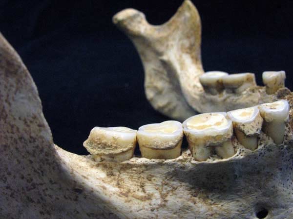 Unterkiefer eines jungsteinzeitlichen Menschen aus der Blätterhöhle: Erkennbar ist der typische Abrieb der Kauflächen sowie Zahnsteinbildung und Spuren einer chronischen Zahnfleischentzündung. Der Abrieb lässt auf den Speiseplan der Steinzeitmenschen schließen, Zahnstein und Parodontose deuten auf wenig ausgeprägte Mundhygiene hin. Noch deutlicher wird das... Unterkiefer eines jungsteinzeitlichen Menschen aus der Blätterhöhle: Erkennbar ist der typische Abrieb der Kauflächen sowie Zahnsteinbildung und Spuren einer chronischen Zahnfleischentzündung. Der Abrieb lässt auf den Speiseplan der Steinzeitmenschen schließen, Zahnstein und Parodontose deuten auf wenig ausgeprägte Mundhygiene hin. Noch deutlicher wird das...