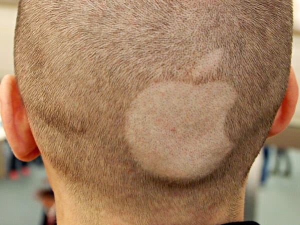 In Sindelfingen trägt ein junger Mann ein rasiertes Apple-Logo auf dem Hinterkopf.