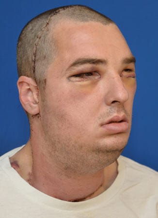 Gesundheit: Im März 2012 wurde dem Amerikaner in der Universitätsklinik der University of Maryland in einer 36-Stunden-OP mit 150 Ärzten und Schwestern ein neues Gesicht gegeben. Unmittelbar nach dem spektakulären Eingriff sah Norris noch aus wie ein verprügelter Boxer. Gesundheit: Im März 2012 wurde dem Amerikaner in der Universitätsklinik der University of Maryland in einer 36-Stunden-OP mit 150 Ärzten und Schwestern ein neues Gesicht gegeben. Unmittelbar nach dem spektakulären Eingriff sah Norris noch aus wie ein verprügelter Boxer.