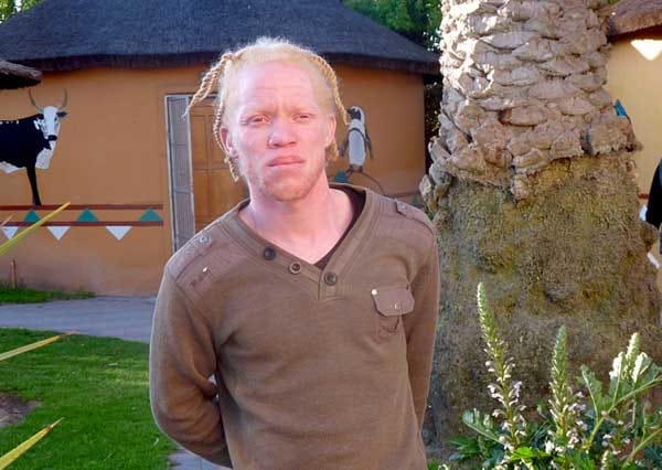 Albinos in Afrika