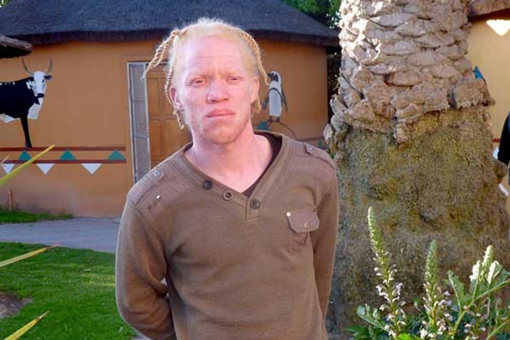 Albinos in Afrika