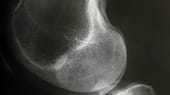 Röntgenaufnahme eines Kniegelenks