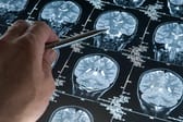 Alzheimer-Forschung: Pharmakonzern Roche erlebt Rückschlag