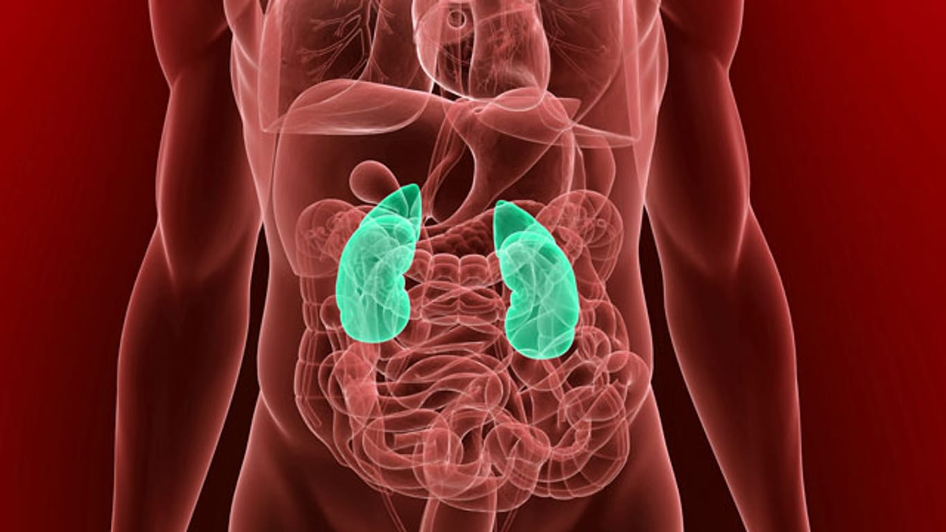 Nierengrieß sammelt sich in den Nieren an und kann zu größeren Nierensteinen zusammenklumpen.