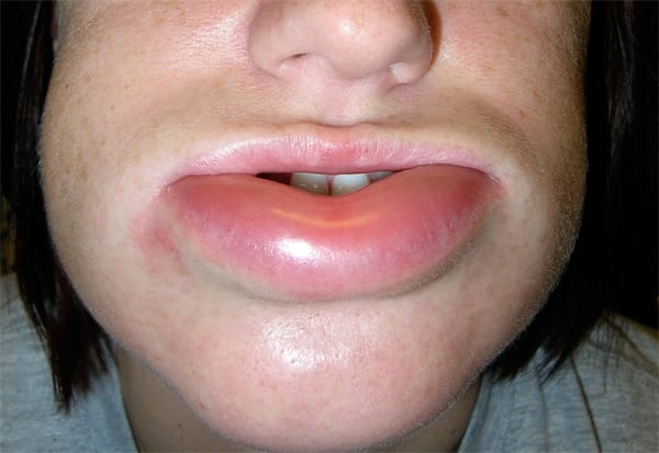 Hereditäres Angioödem (HAE): Betroffene leiden oft unter starken Schwellungen im Gesicht.