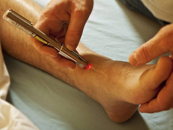 Laserakupunktur zur Behandlung von Narben