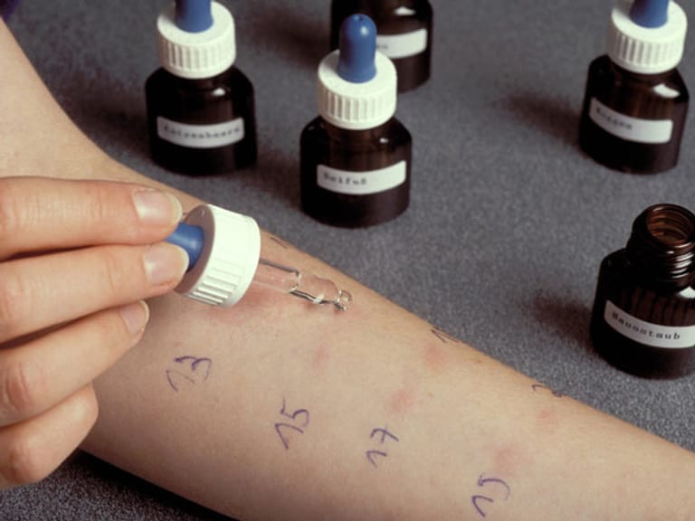 Allergietests werden häufig an der Haut durchgeführt