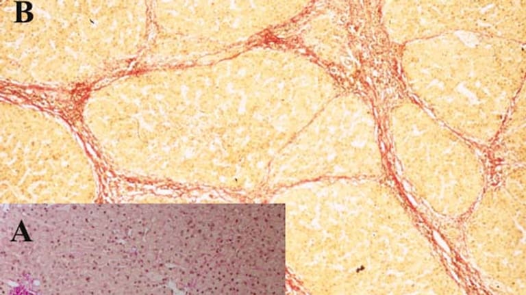 Leberzirrhose: B zeigt eine mikroskopische Aufnahme einer zirrhotischen Leber. Das Bindegewebe ist rot gefärbt, die Leberzellen sind orange. Die gesunde Leber (A) zeigt diese Bildungen im Gewebe nicht.