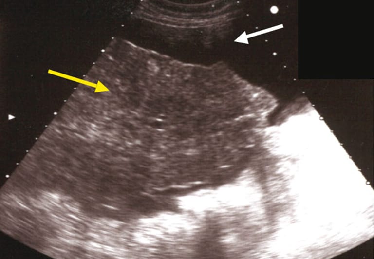 Leberzirrhose: Die sonographische Ansicht zeigt, dass die kranke Leber höckerig ist (gelber Pfeil). Der weiße Pfeil zeigt eine Flüssigkeitsansammlung im Bauchraum.