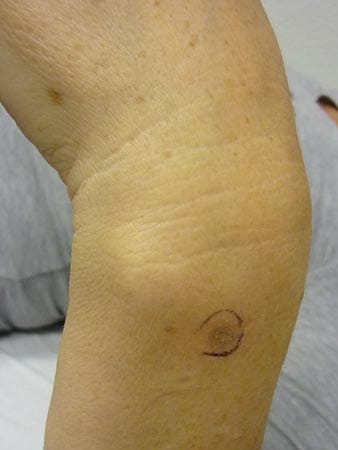 Aktinische Keratosen: Hier sieht man aktinische Keratosen auf dem Handgelenk einer Frau. Die Stelle ist gerötet und rau.