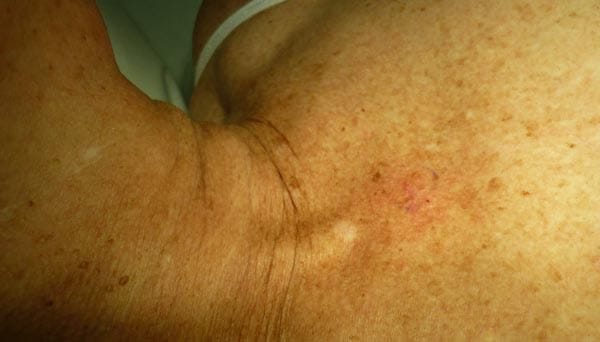 Aktinische Keratosen: Aufgrund der Hautfärbung im Brustbereich dieser Frau fällt die aktinische Keratose kaum auf. Doch: In jedem fünften Fall kann sich daraus heller Hautkrebs entwickeln.
