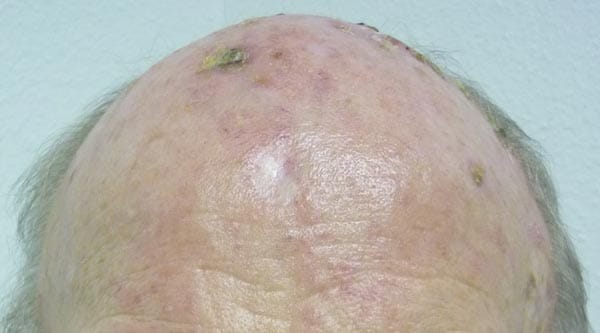 Aktinische Keratosen: Die aktinischen Keratosen auf der Stirn dieses Mannes sind bereits ausgeprägt und deutlich sichtbar. Die Haut zeigt eine schorfige Veränderung.