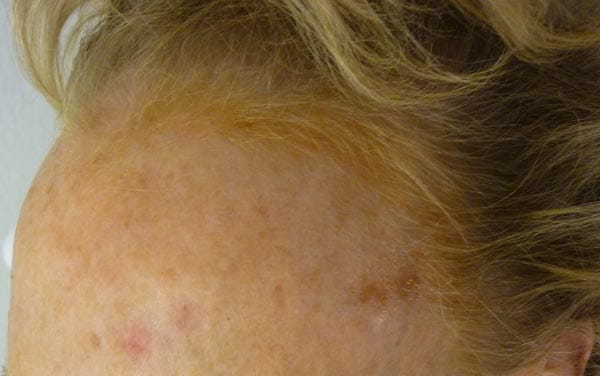 Aktinische Keratosen: Auch auf der Stirn dieser Frau ist die Hautveränderung deutlich zu erkennen. Die Hautareale, die häufig der Sonne ausgesetzt sind, sind besonders gefährdet.