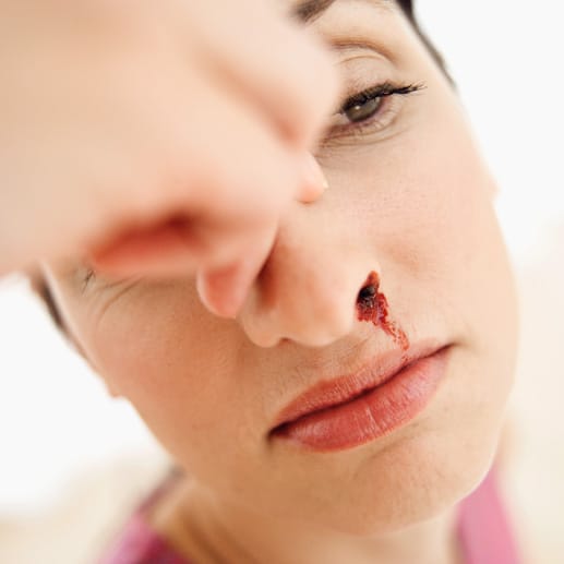 Nasenbluten: Den Kopf zurückzulegen, hilft nicht, den Blutfluss zu stoppen. Vielmehr gerät der blutige Schleim durch Schlucken in den Magen, was häufig zu Übelkeit führt.