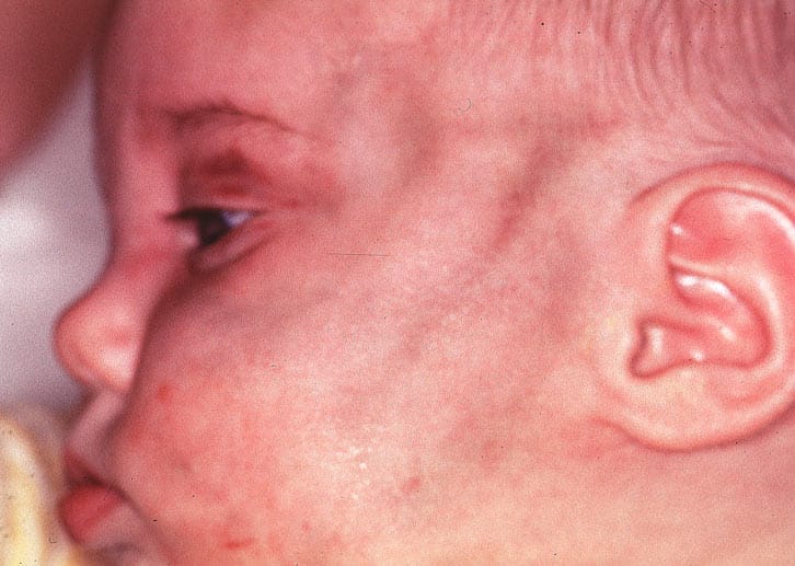 Kindesmisshandlung: Blutergüsse im Gesicht eines Babys