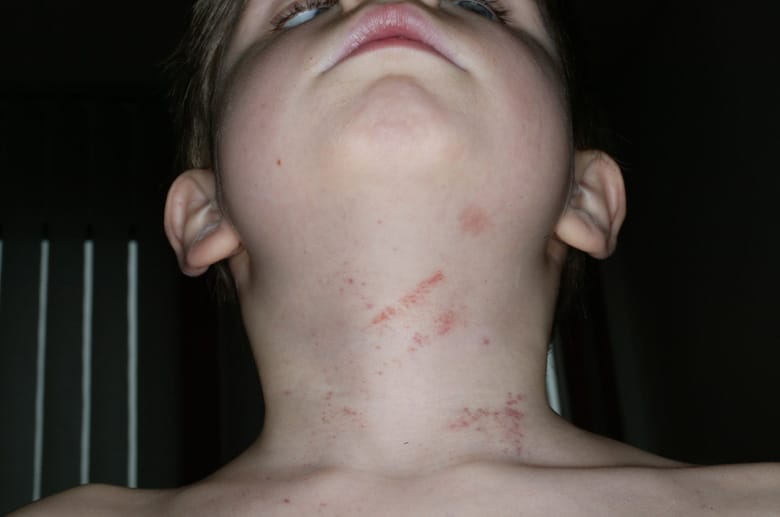 Kindemisshandlung: Würgemale am Hals eines siebenjährigen Jungen.