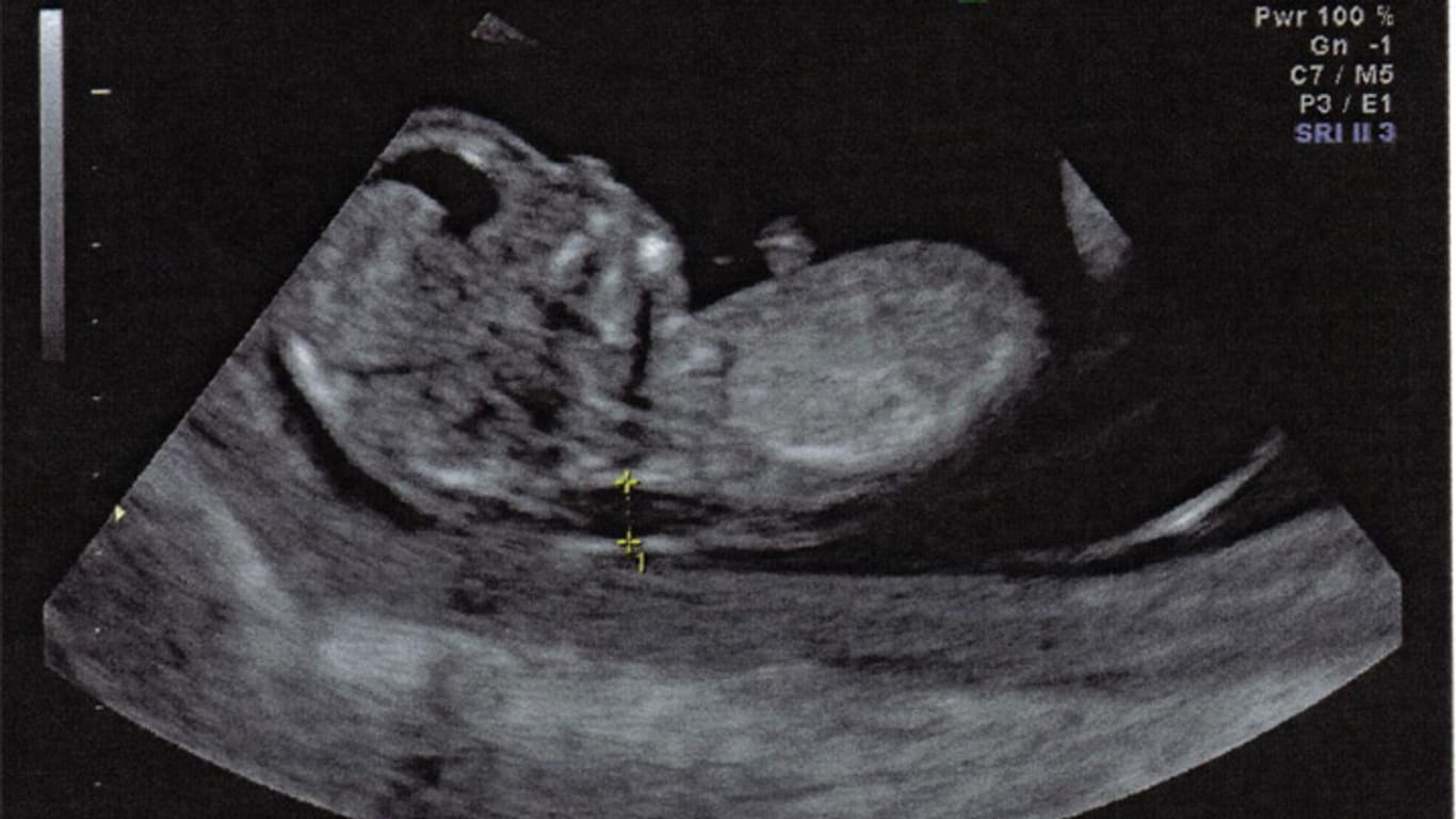 Ultraschallbild von Zoe
