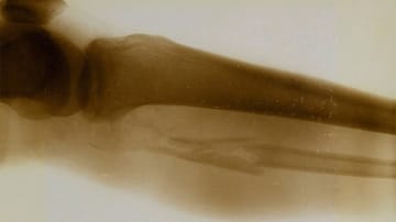 Röntgenbilder aus dem Ersten Weltkrieg