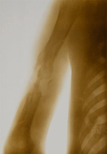 Röntgenbilder aus dem Ersten Weltkrieg