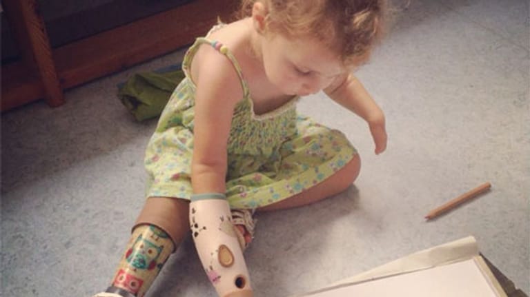 Damit Emily das Greifen lernen kann, hat sie myoelektrische Handprothesen erhalten. Eingebaute Elektroden leiten Impulse über die Haut weiter und setzen so die künstlichen Finger in Bewegung.