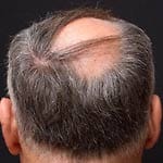 Eine Glatze am Hinterkopf ist für viele unerträglich. Eine Haartransplantation kann da Abhilfe schaffen.