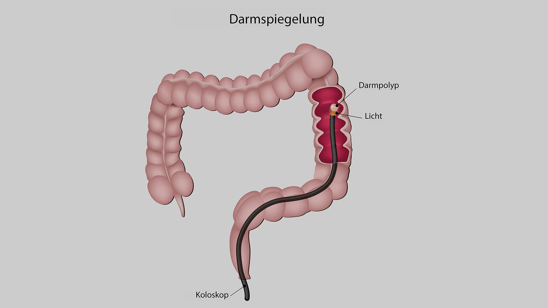 Bei einer Darmspiegelung schiebt der Arzt das Koloskop mit der Kamera durch den Dickdarm.