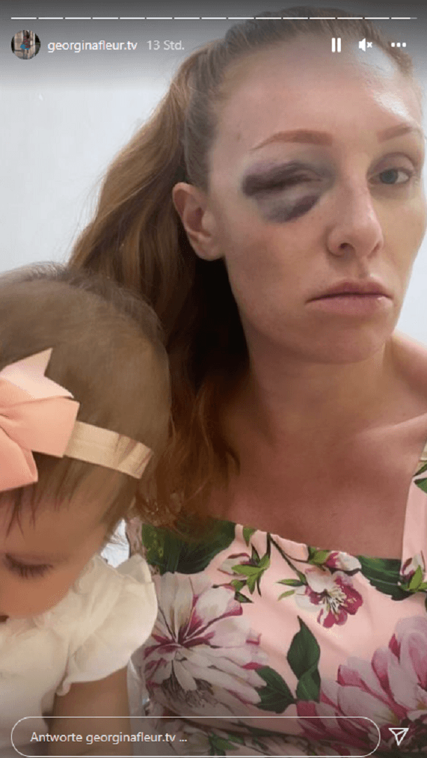 Georgina Fleur und ihre Tochter: Die Mutter hat ein stark geschwollenes Auge.