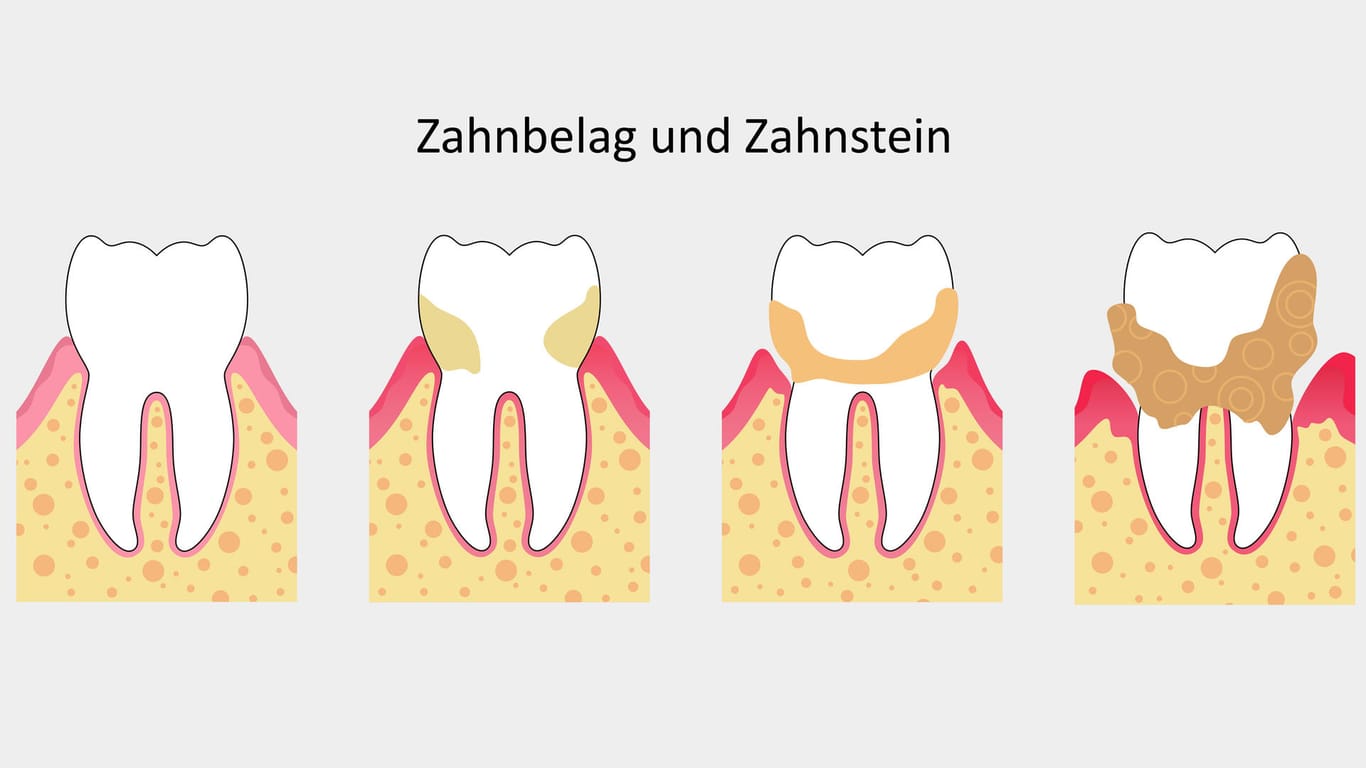 Bildung von Zahnbelag und Zahnstein