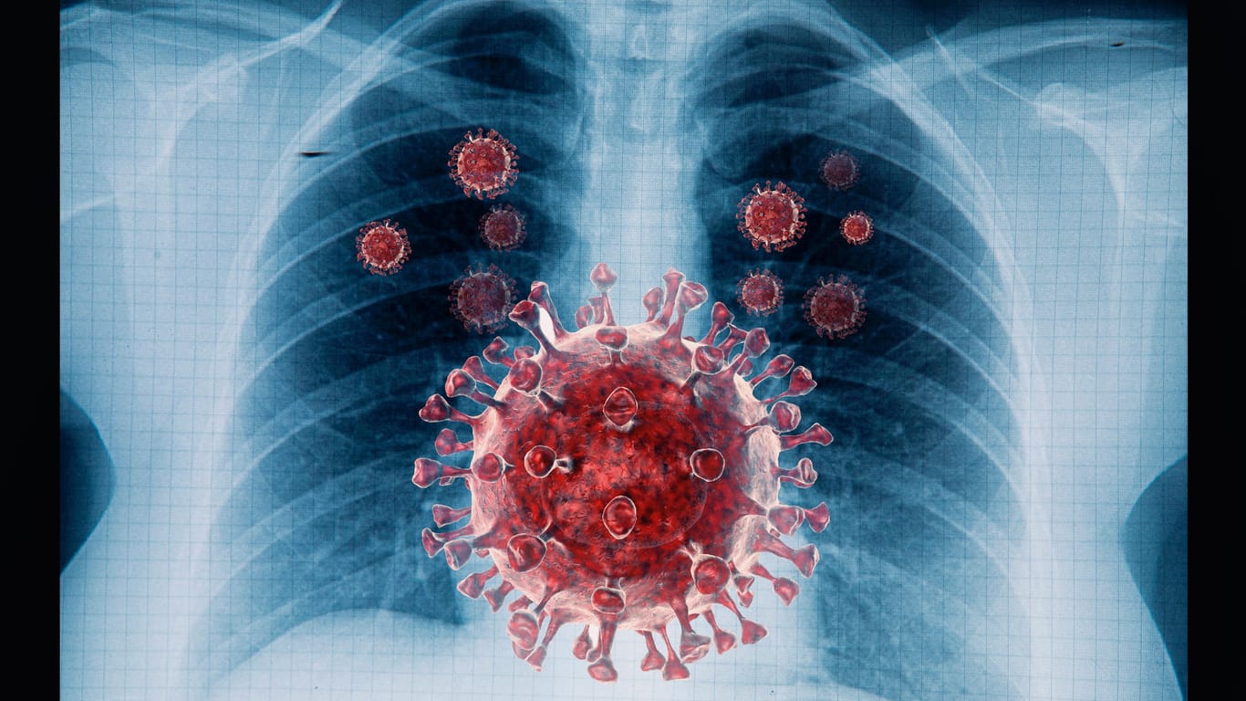 Lungenembolie: Wie lange besteht ein erhöhtes Risiko nach einer Corona-Infektion?