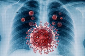 Lungenembolie: Wie lange besteht ein erhöhtes Risiko nach einer Corona-Infektion?