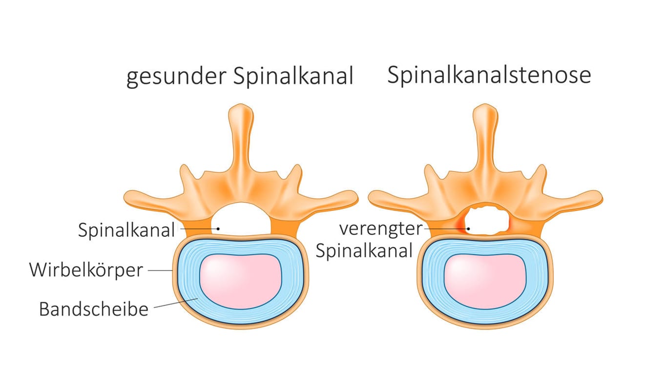 Anatomische Darstellung der Spinalkanalstenose.