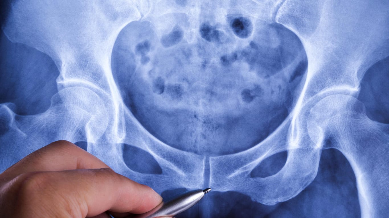 Röntgenbild eines Steißbeinbruchs (Symbolbild): Ist der Knochen gebrochen, zeigt sich das bei bildgebenden Verfahren.